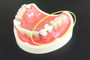 従来の入れ歯