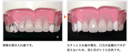 入れ歯の新調:口元の金属のバネが見えないタイプ