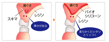 入れ歯の新調:やわらかいシリコーンタイプ