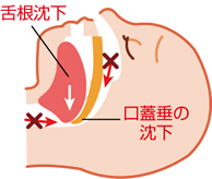 無呼吸の状態