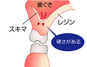 従来の入れ歯の場合